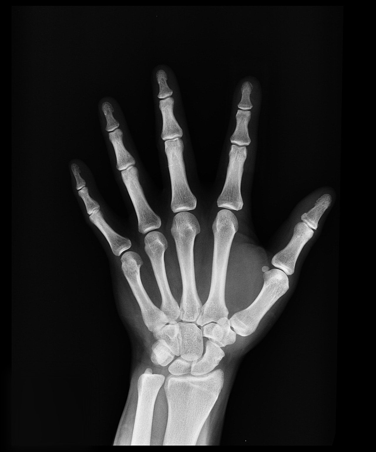 hand x-ray radiograph